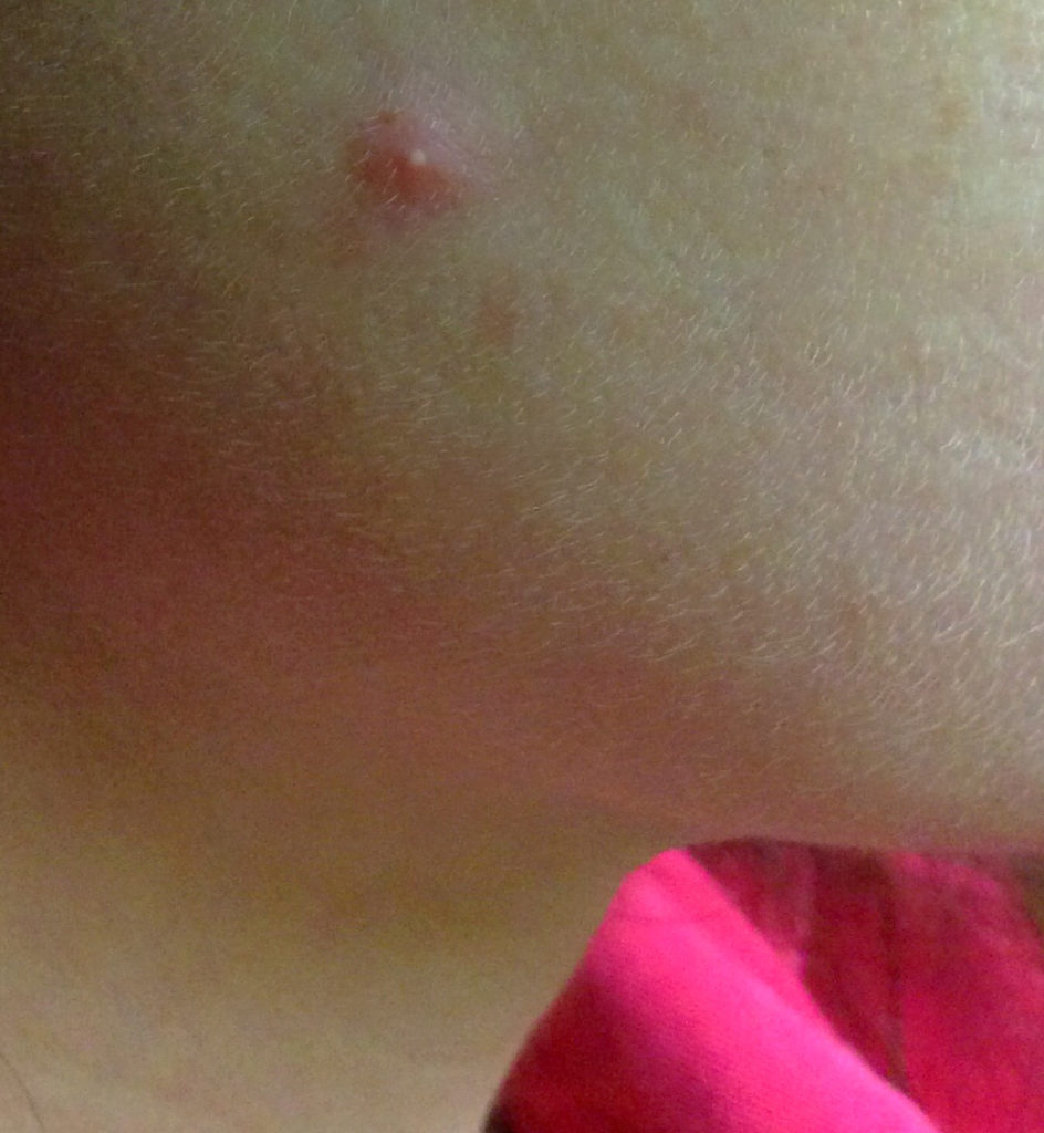 Our reVive light therapy acne test case pimple