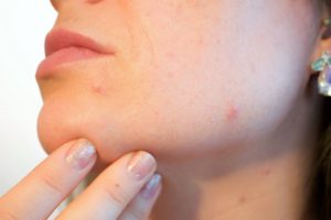 Treat acne with Hemp Seed Oil and reduce inflammation